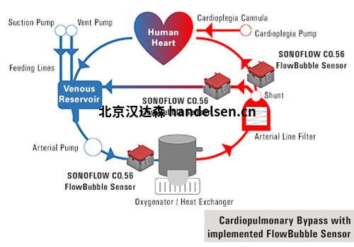 Kardiopulmonaler-Bypass_SONOFLOW-CO.56-Pro-Flow-Bubble-Sensor_SONOTEC